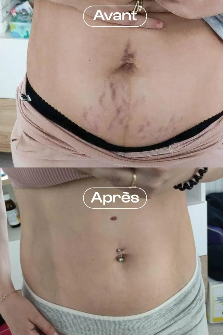 Concentré correcteur vergetures L’Expert